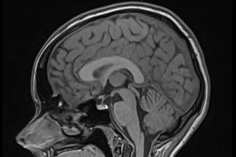 Brain MRI